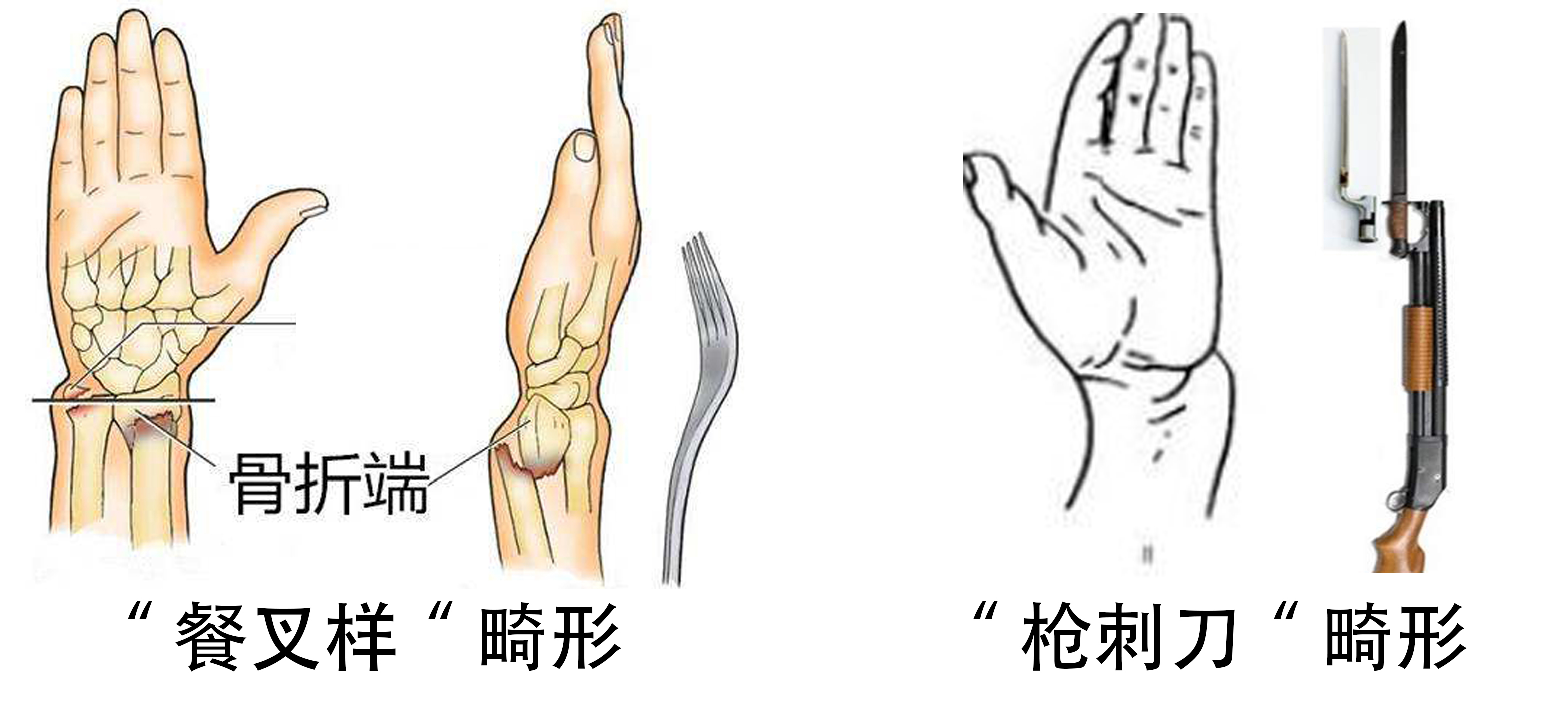 手腕骨折与桡骨远端骨折哪样严重,老年人手桡骨骨折多久能恢复