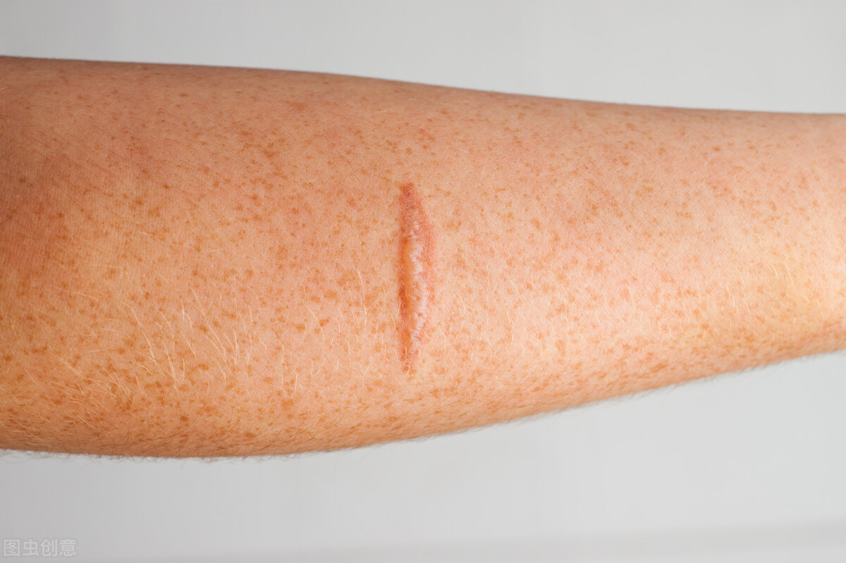 60天修复疤痕的偏方是真的吗,修复疤痕最有效的秘方