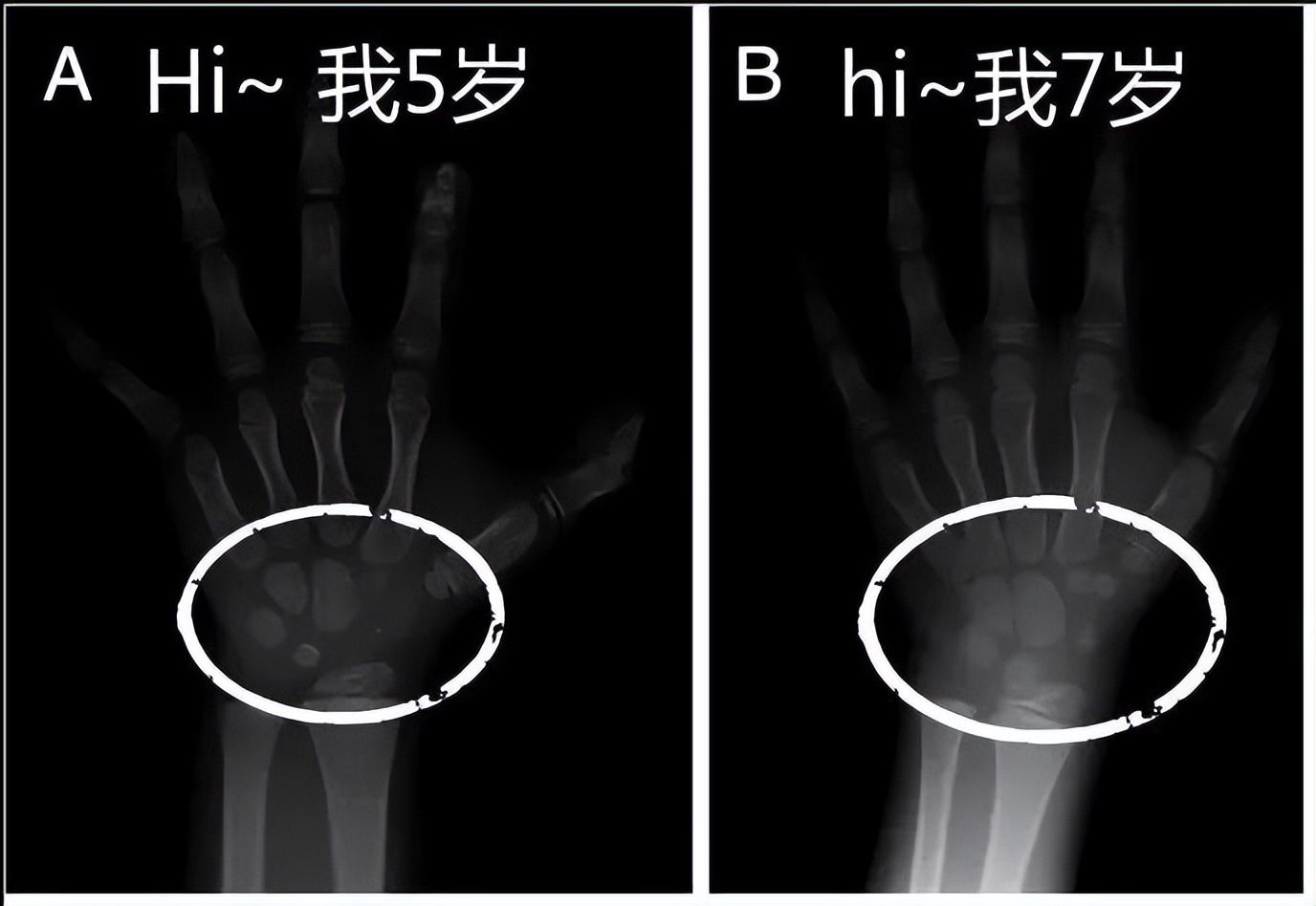 孩子骨龄偏大1岁多怎么控制骨龄,孩子骨龄偏小两岁怎么治疗
