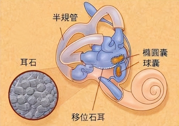 耳朵里好像有个小石头头一摇就响,耳朵里小石头掉了