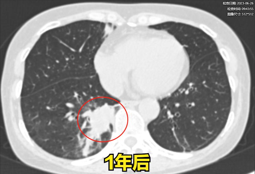 肺癌穿刺活检会使癌症发展得快吗,肺癌穿刺活检的风险