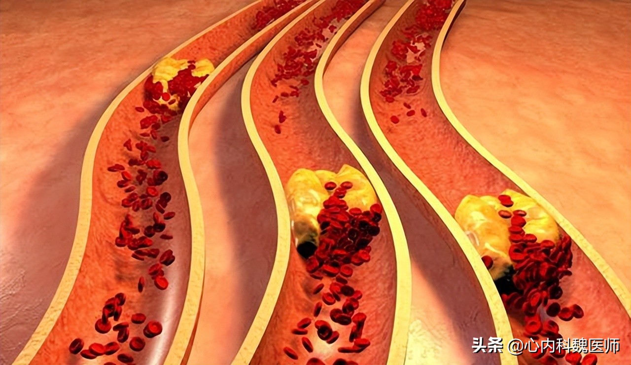 男性可以吃叶酸预防心脑血管疾病,男性补充叶酸对精子的影响