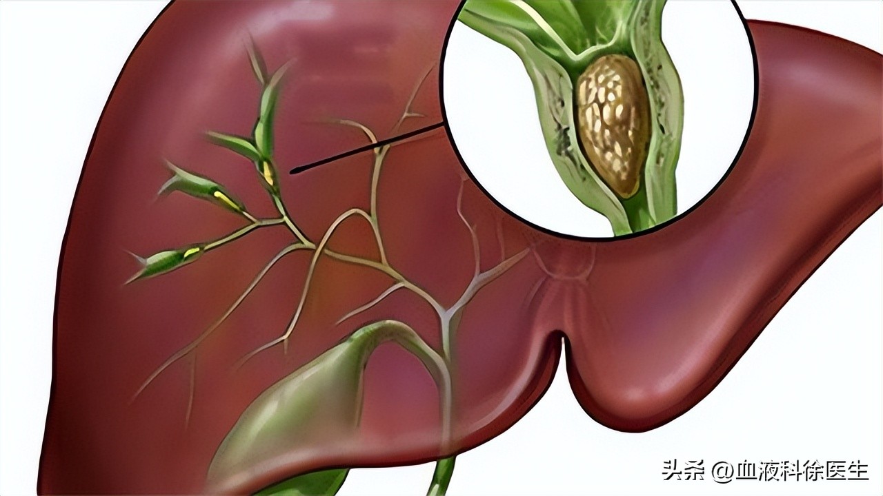 胆管癌的早期4大症状是什么呢,发现胆管癌要注意这4点