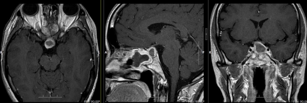 30岁就“停经”正常吗？警惕垂体瘤