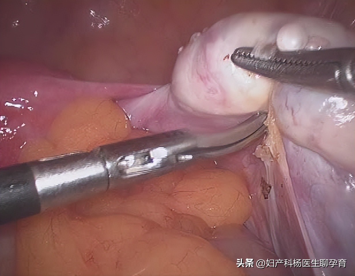 有卵巢囊肿又有多囊卵巢综合征,卵巢囊肿超声检查一般显示什么