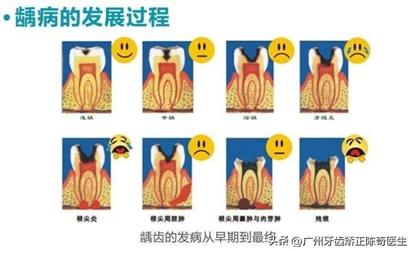 小孩子大牙蛀牙严重怎么办,为啥有的小孩满嘴蛀牙都掉完了