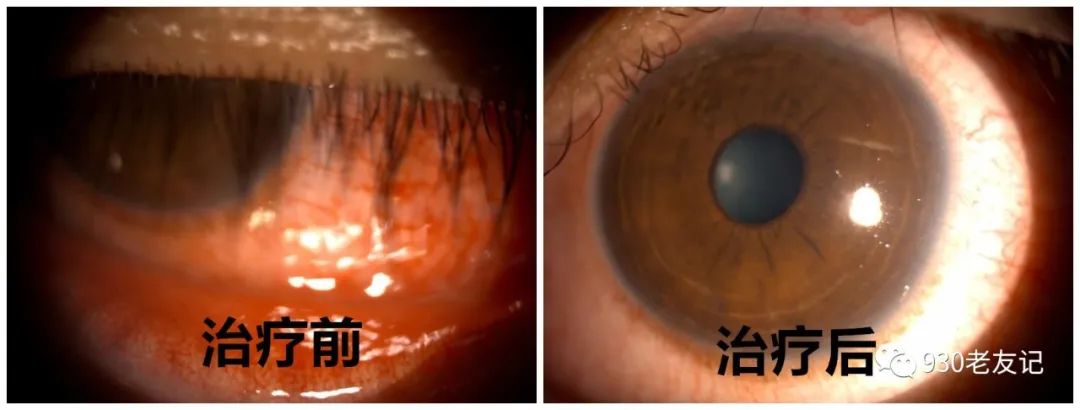 用酒店毛巾后被确诊淋病,广西男子患上淋病