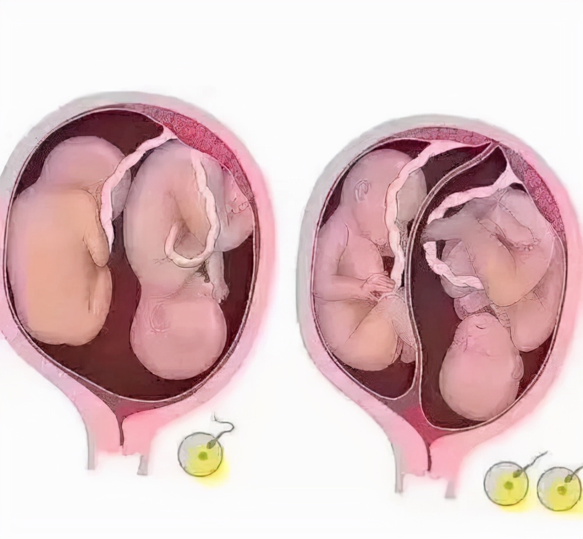 连体人结婚是怎样过日子,连体人如何娶妻生子