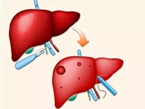 有个小囊肿要注意什么,医生诊断囊肿就一定是囊肿吗
