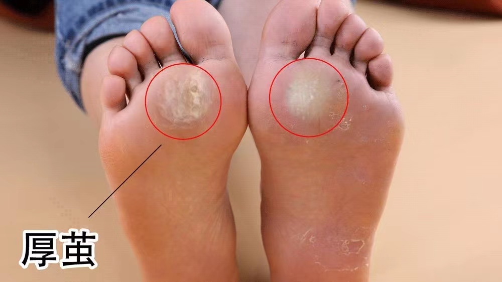 脚底板爱进风什么原因,脚底板长茧子走路疼怎么办
