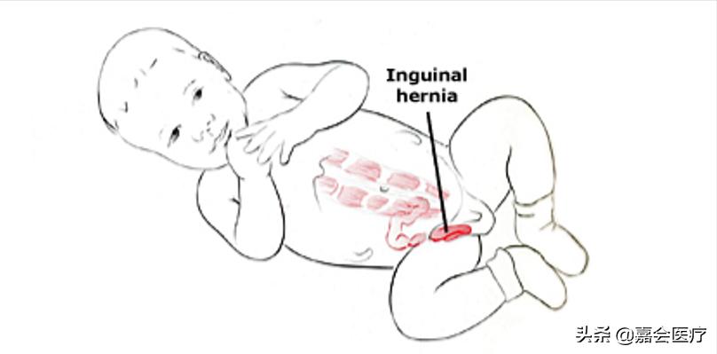 小儿腹股沟疝气是因为哭引起的吗,三个月宝宝有疝气总是哭怎么办
