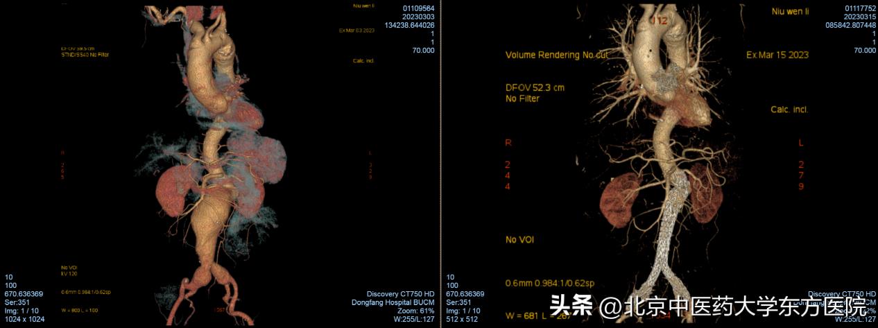 北京中医药大学东方医院成功完成首例保留双侧髂内动脉的巨大腹主动脉瘤合并双侧髂动脉瘤腔内隔绝术！