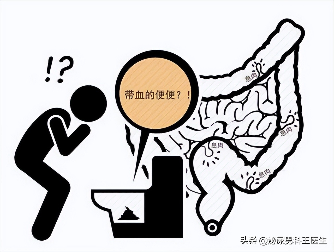 直肠癌早期身体发出3个救命信号,直肠癌症状是先下坠还是便血