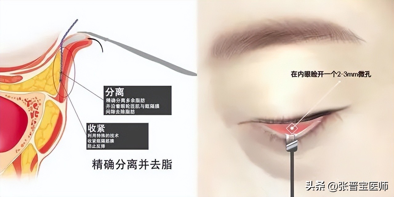 44岁女做眼袋切除适合吗,眼袋手术28岁