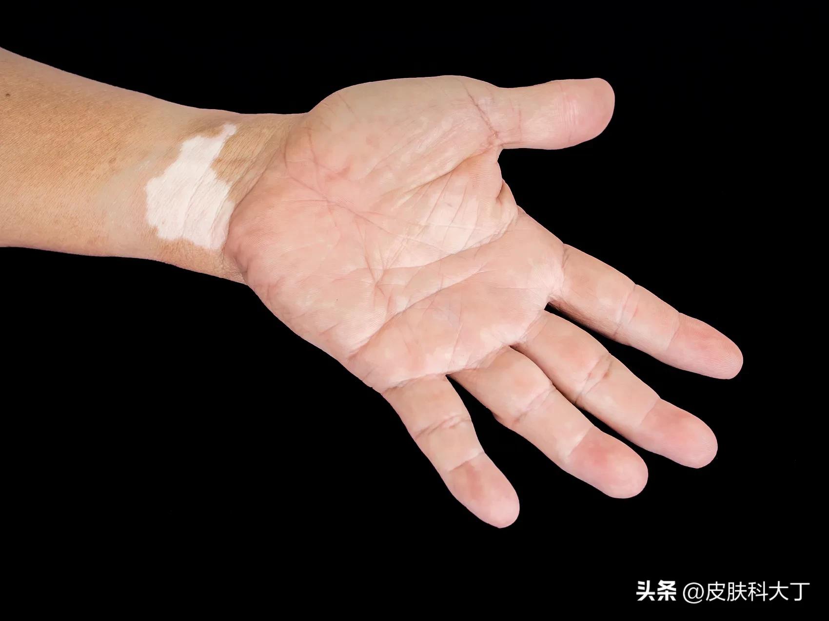 怎么让白癜风黑色素全部退掉,手上白癜风最佳治疗方法