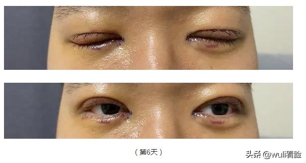 男生割双眼皮的意思,男生眼睛小割双眼皮会好看吗