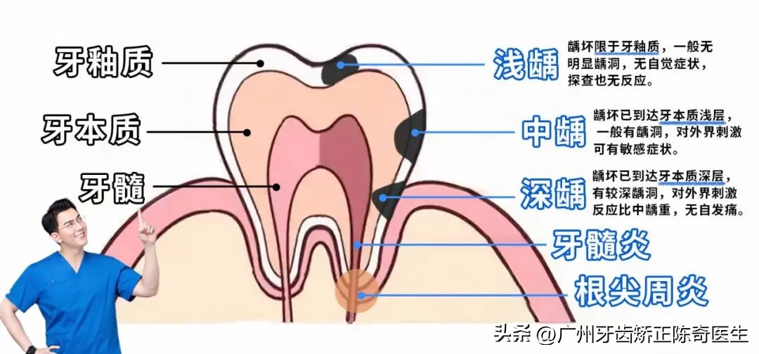 如何有效帮助孩子预防龋齿,预防儿童龋齿请家长们积极动起来