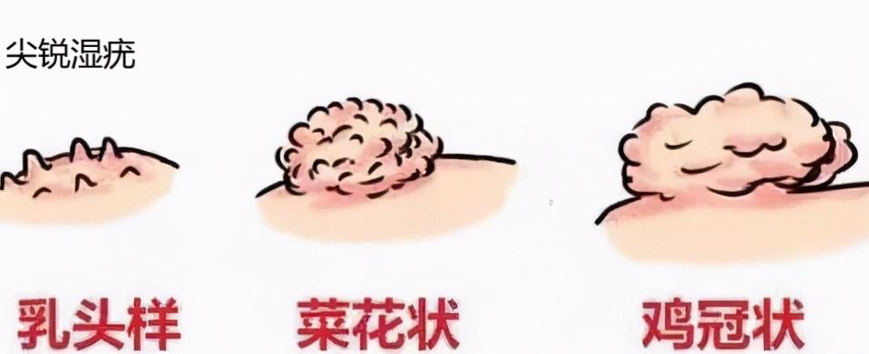 感染hpv且tct阳性能备孕吗,备孕期间发现有hpv感染怎么办