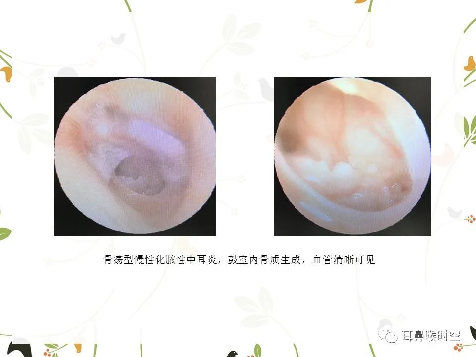 鼓膜可见穿孔,鼓膜穿孔听力下降能恢复吗