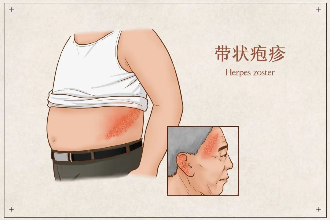 传染病水痘的介绍,常见传染病麻疹水痘