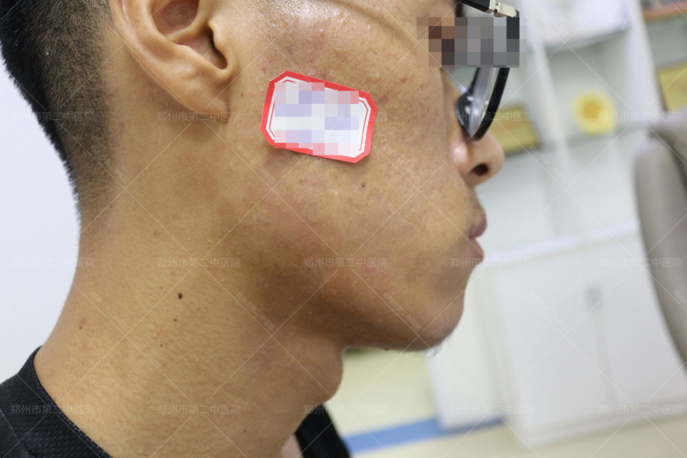 中医怎样治疗增生性疤痕疙瘩,郑州市第二中医院疤痕科祛痘坑