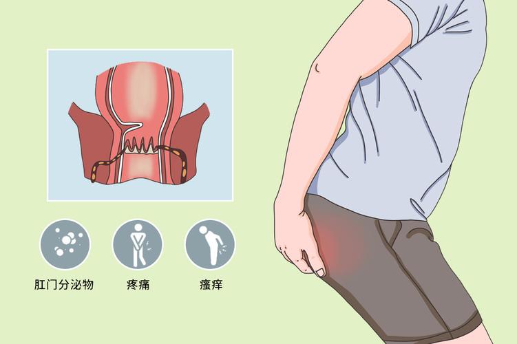 肛周脓肿用拔毒生肌散,肛周脓肿中医方剂