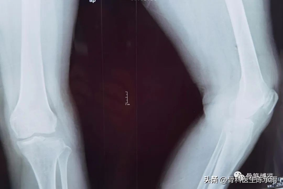 膝关节胫骨平台骨折,最近胫骨平台骨折视频