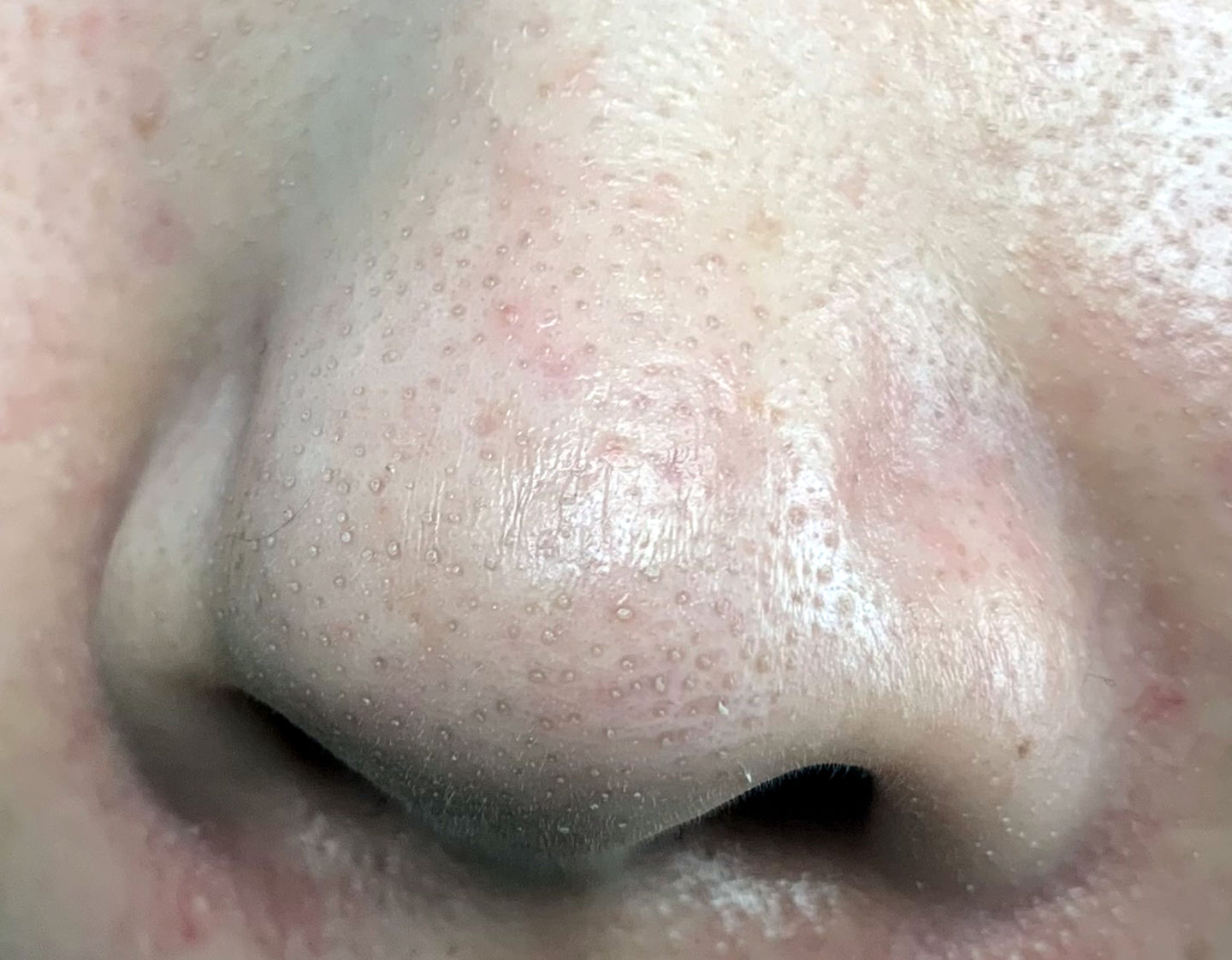 真黑头怎么去,黑头用黑头膏为什么去不掉黑头