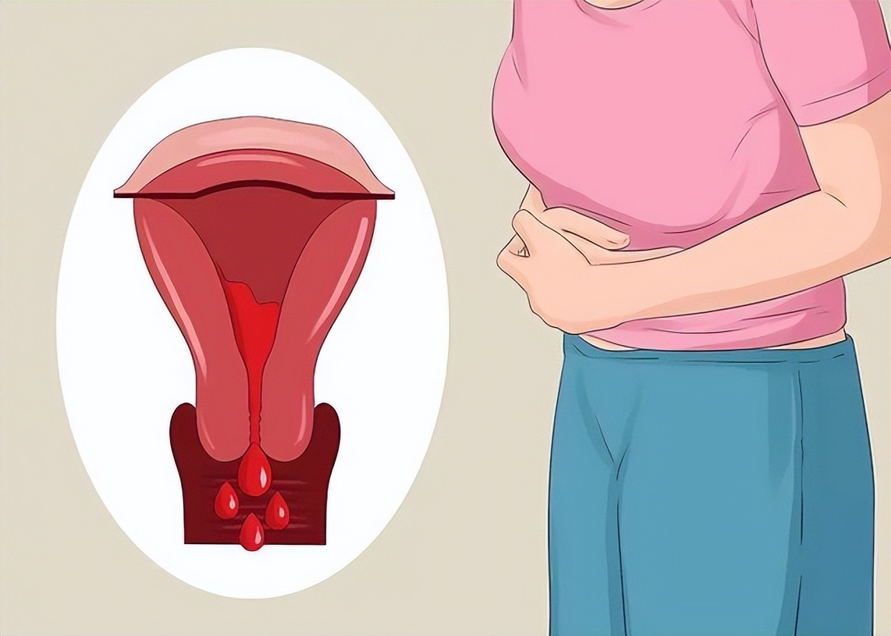 益气活血软坚汤卵巢囊肿,卵巢囊肿能喝散结汤吗