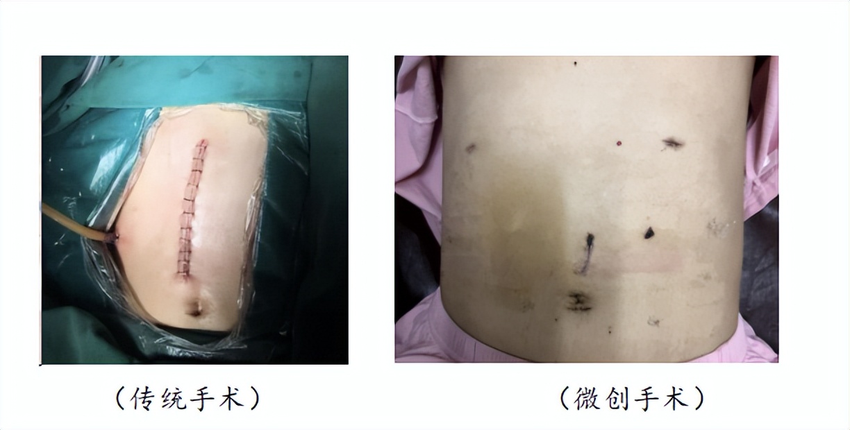 小儿胆总管囊肿开刀手术,腹腔镜胆总管结石手术打孔位置