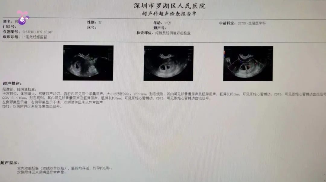 监测排卵可以怀双胞胎吗,排卵前吃什么容易怀双胎