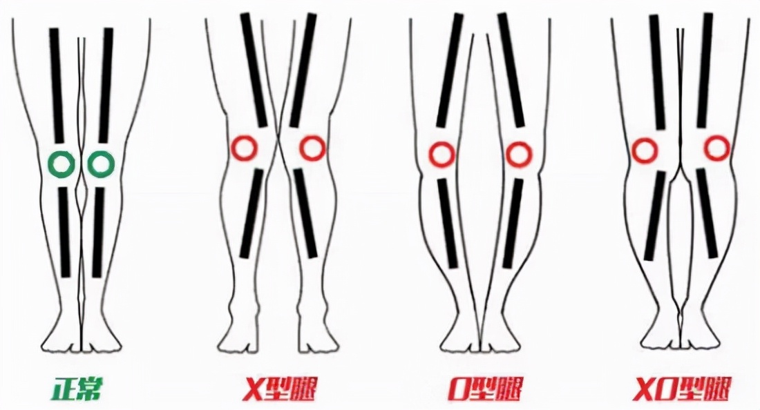 xo型腿是什么样的,xo型腿的矫正方法