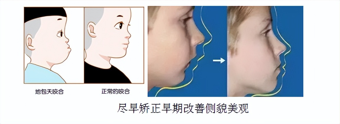 孩子长的兔子牙导致嘴唇突出矫正,孩子牙地包天需要矫正吗