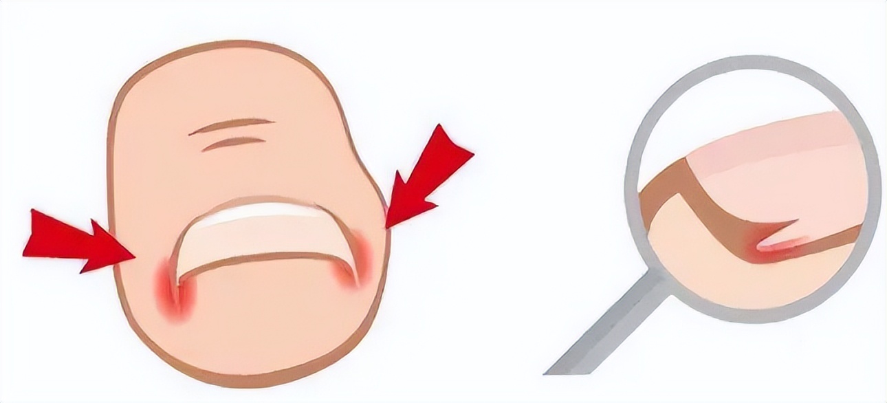 怎么治疗甲沟炎最快最好的方法,如何治疗甲沟炎效果最佳