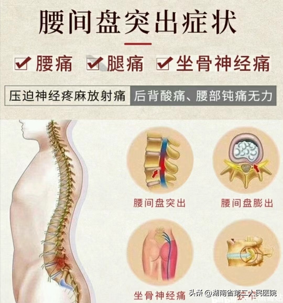 一个小技巧避免腰椎间盘突出,对于腰间盘突出最权威的解读