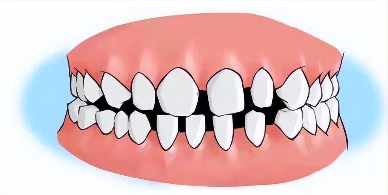 树脂补牙缝和贴面哪个好,牙缝大正畸还是贴面