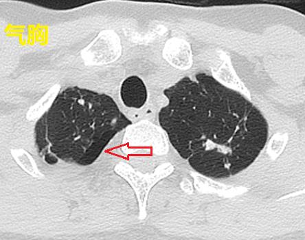 肺脓肿导管引流,肺脓肿的引流管脱落怎么办