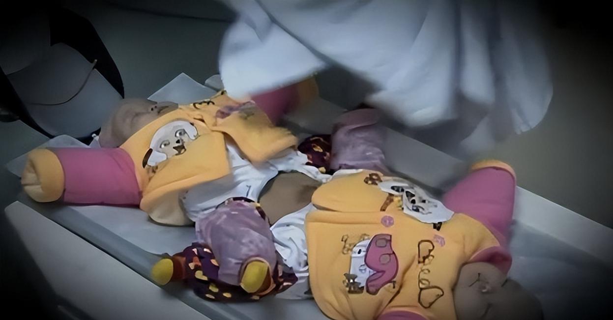 连体婴姐妹18年成功分离,连体婴姐妹成功分离后续