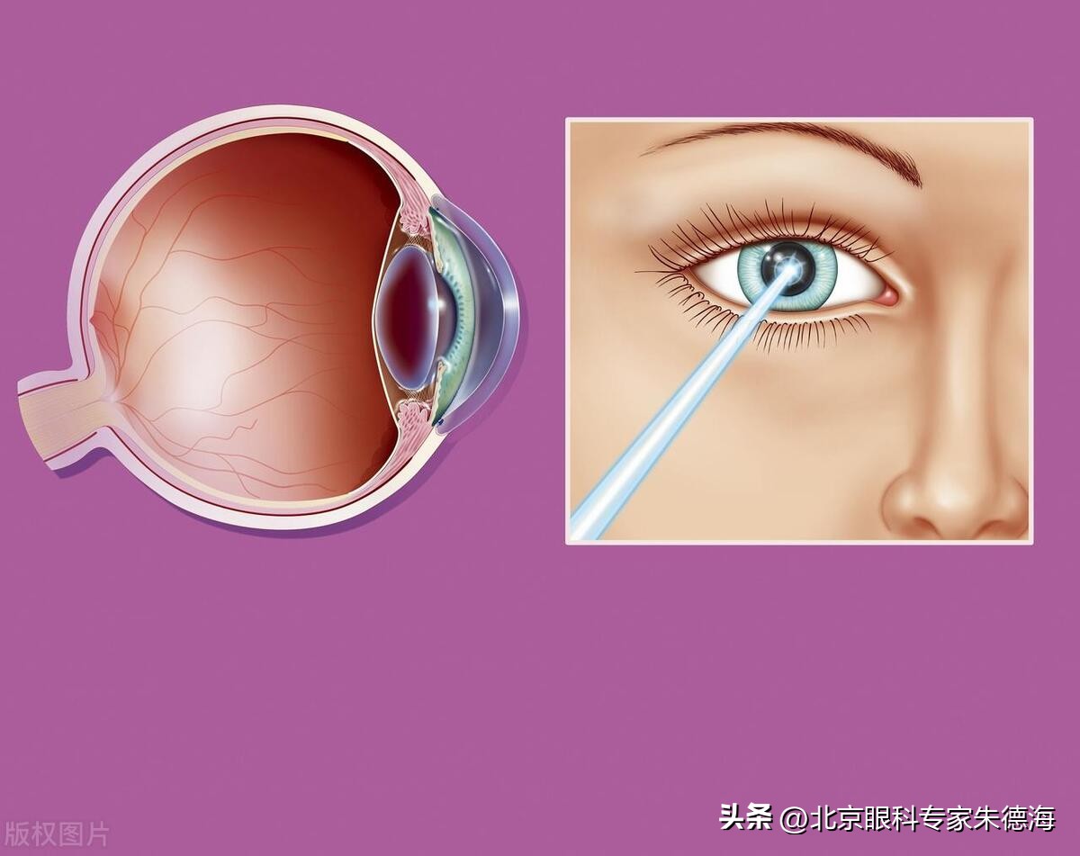 激光近视矫正手术有什么后遗症,激光近视手术老年后有后遗症吗