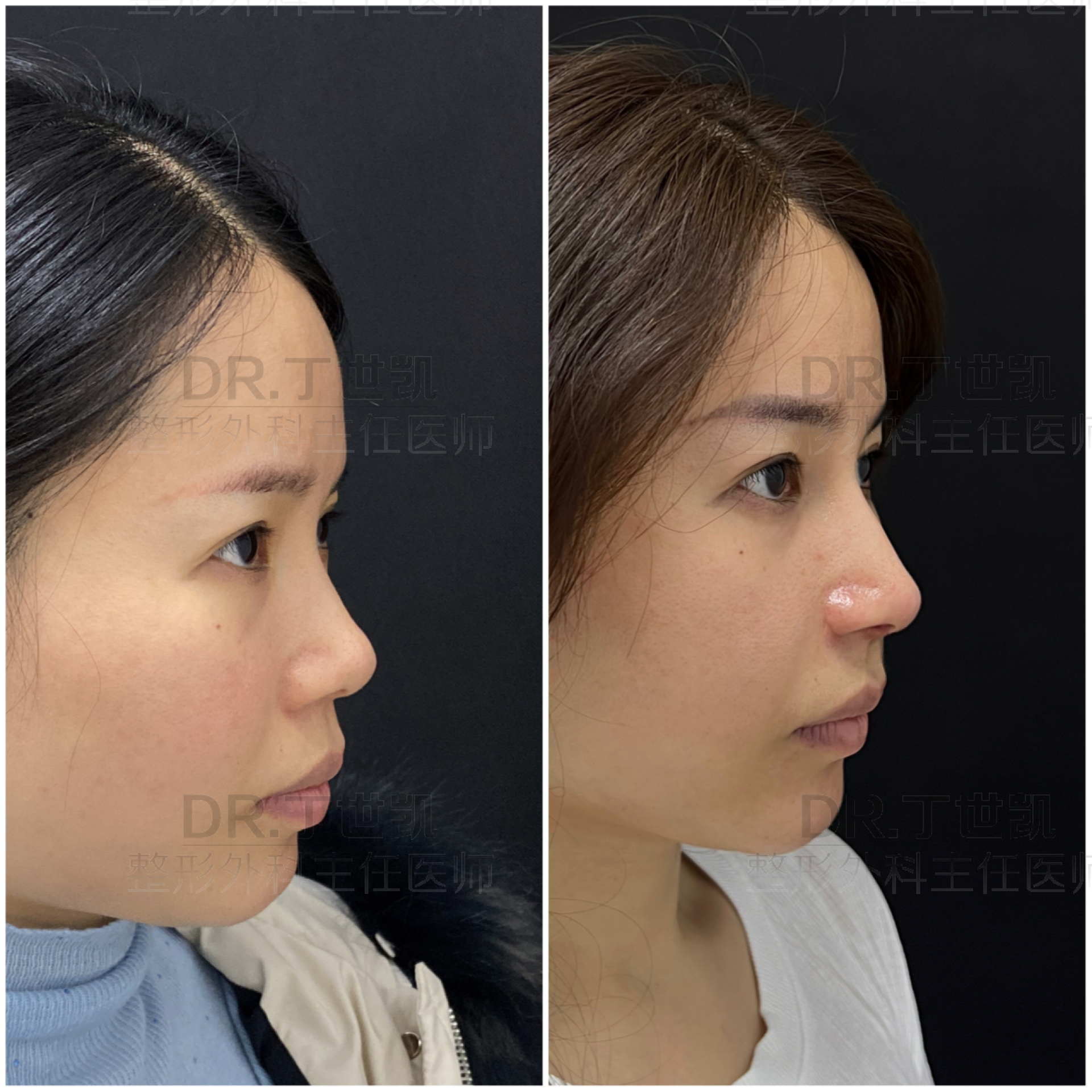 隆鼻三个月鼻子发红不痛不痒,隆鼻发炎鼻尖发红吃什么药