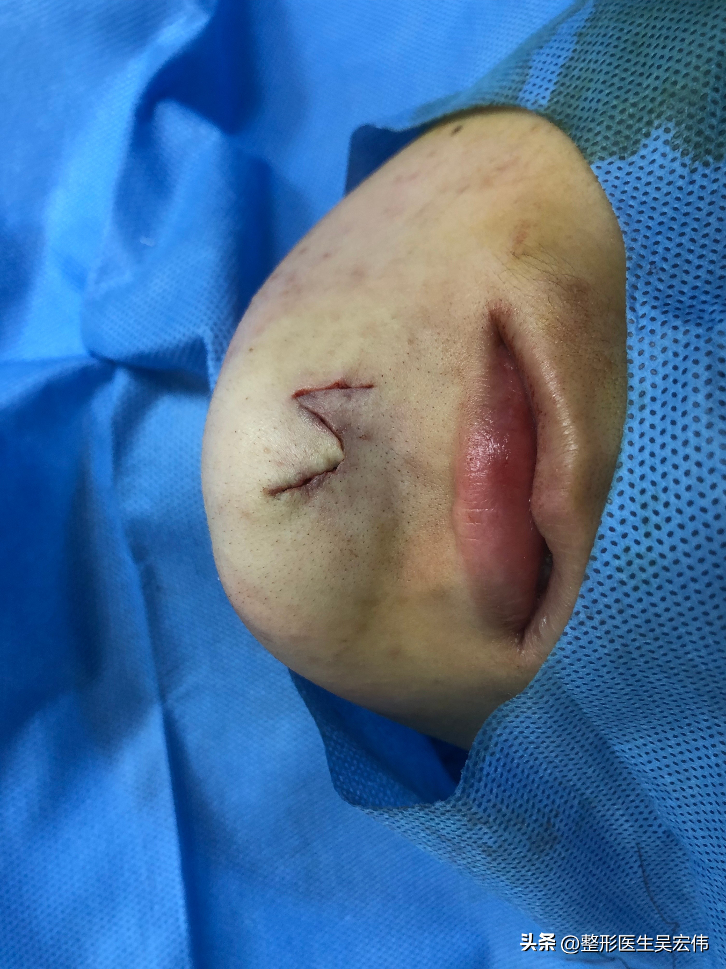 面部痣切除缝合不平整,面部痣可以去掉吗