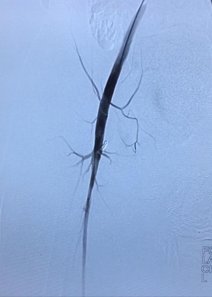 下肢静脉血管瘤,动静脉血管畸形微创介入