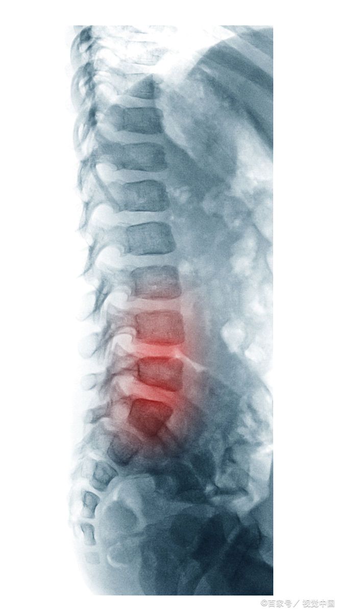 下肢麻木疼痛用什么药,下肢麻木疼痛行走多了加重
