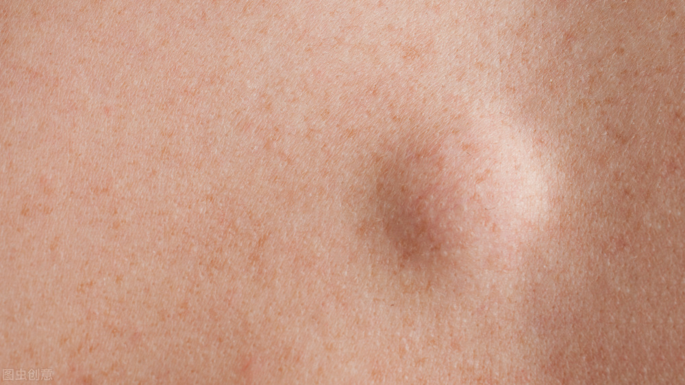 脂肪瘤形成的原因及治疗,脂肪瘤发病原因是什么怎么治疗