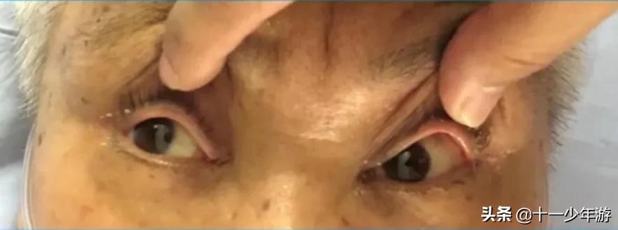 大脑的结构解剖示意图,大脑镰下疝解剖结构