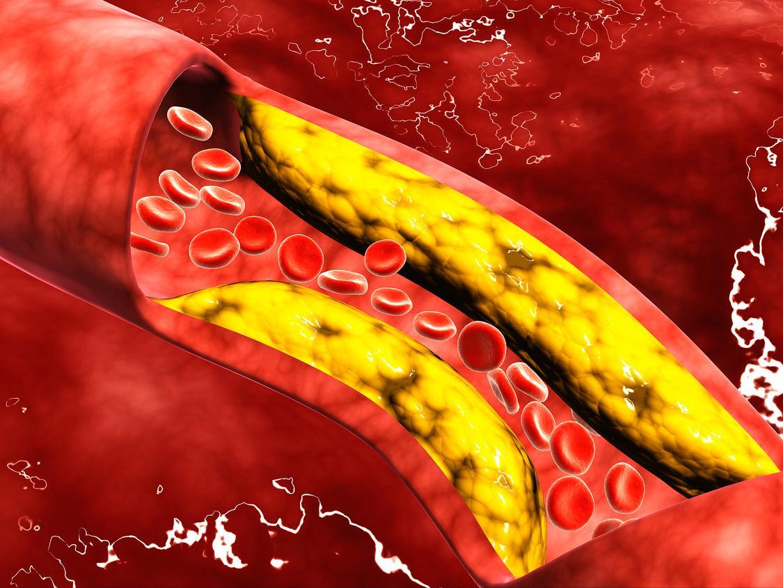 血管狭窄80%必须放支架吗,血管狭窄50%至60%要放支架吗