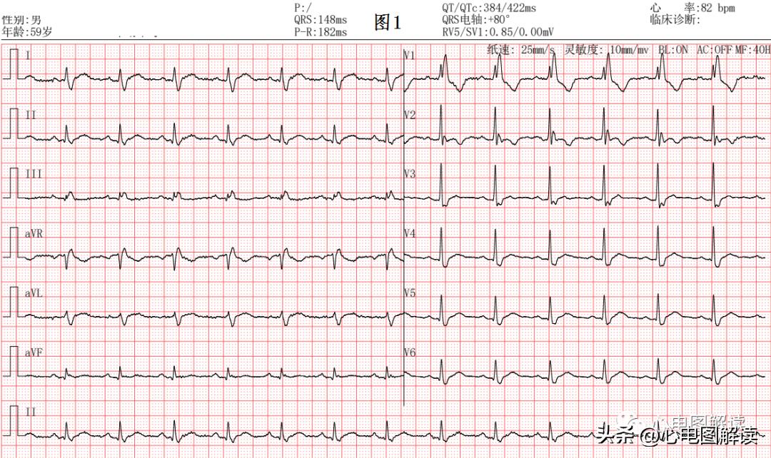 完全性右束支阻滞有什么症状吗,完全性右束支传导阻滞的中成药
