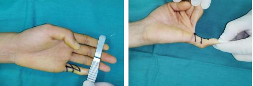 有一个手指伸不直,第一节手指伸不直