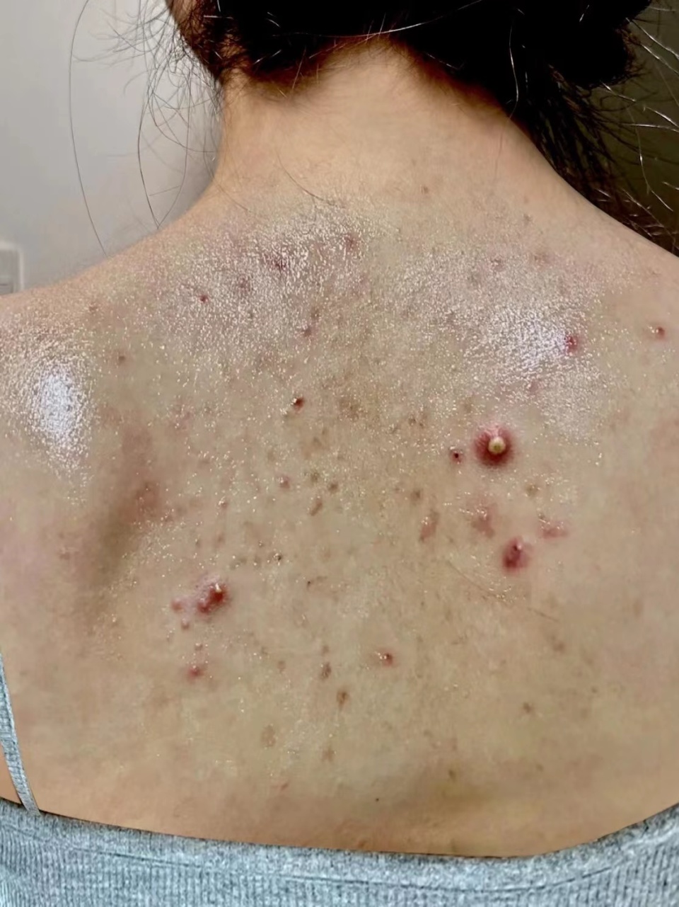 脓包痘消炎祛痘印用什么,祛痘脓包型