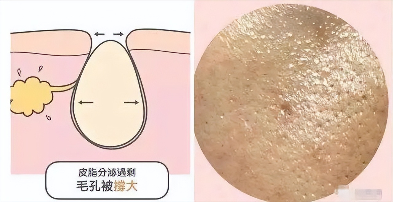 解决毛孔粗大的方法收藏起来,解决毛孔粗大的秘籍你值得拥有